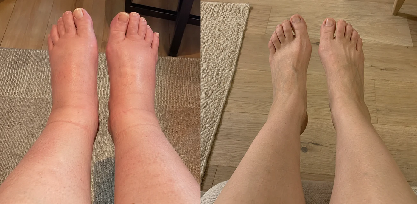 Swollen legs and feet before, slim and comfortable after
